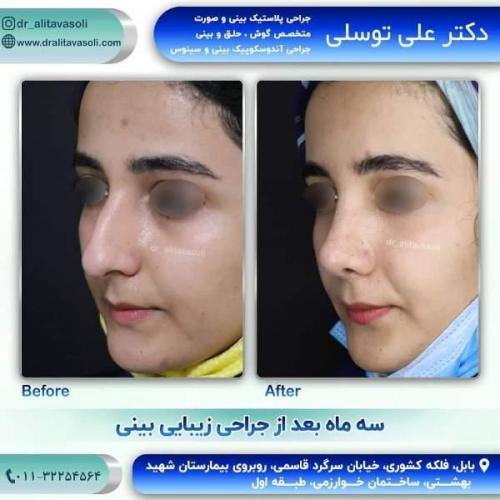 جراحی بینی 150 (6)