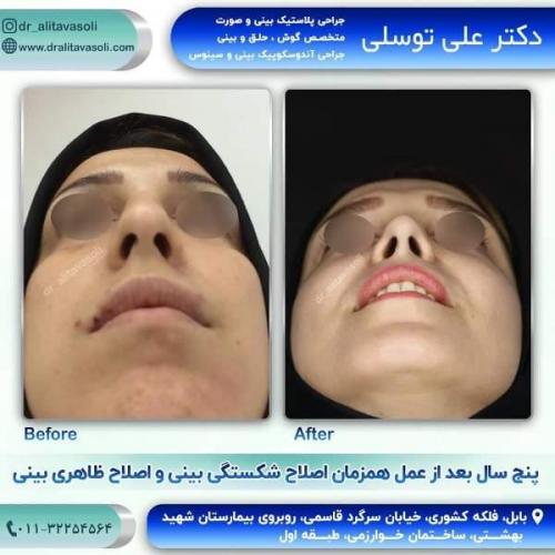 جراحی بینی 150 (62)