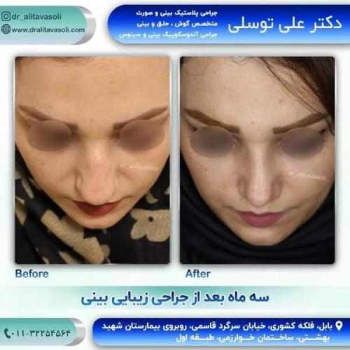 جراحی بینی 150 (9)